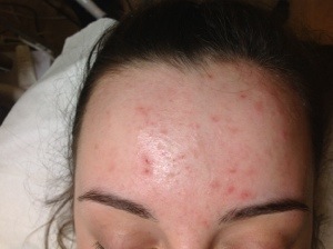 Teenager with acne