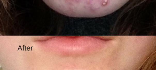 Acne Treatment Nottingham